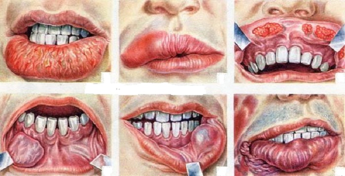 spot oral cancer