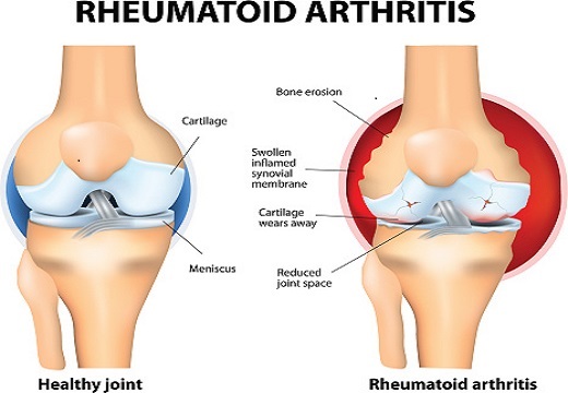 Arthritis and joint pain relieving