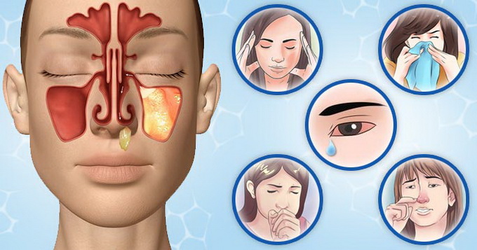 Can allergies cause sinus infection