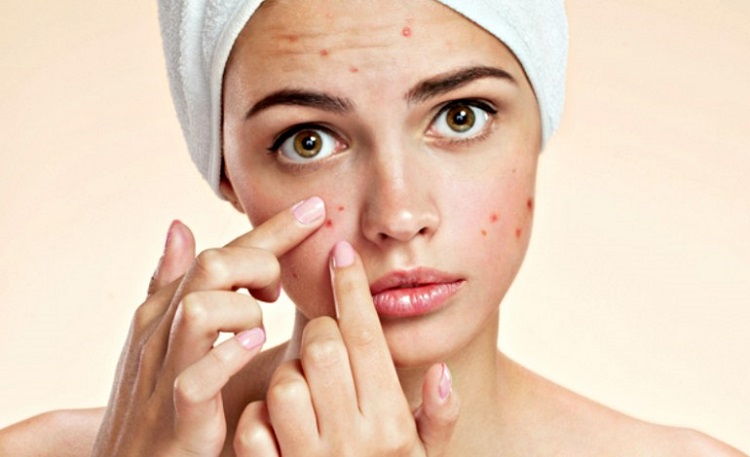 Get rid of pimples in a natural way