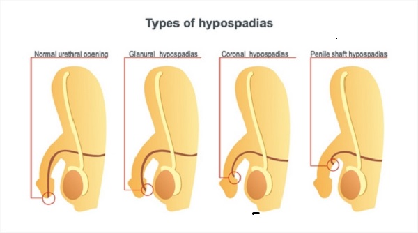 hypospadias - types