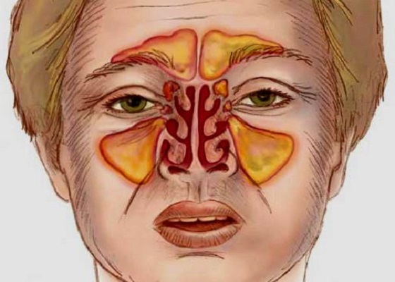 Infected sinus cavity