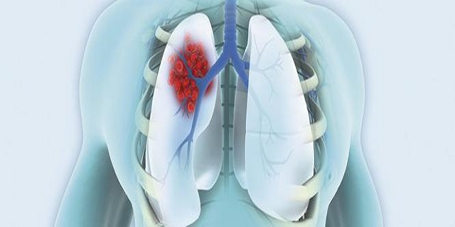 Small cell lung cancer symptoms