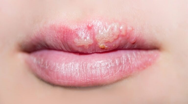 Viral cold sore