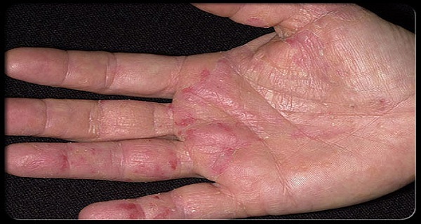 cancer symptoms - hands