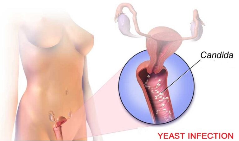 cure vaginal yeast infection