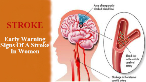 early warning signs of a stroke in women