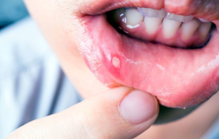 Eliminate Canker Sores In The Mouth Naturally In Just One Day