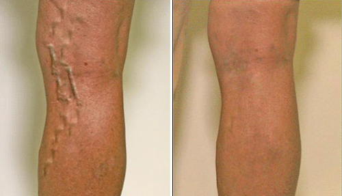 how to treat and prevent varicose veins