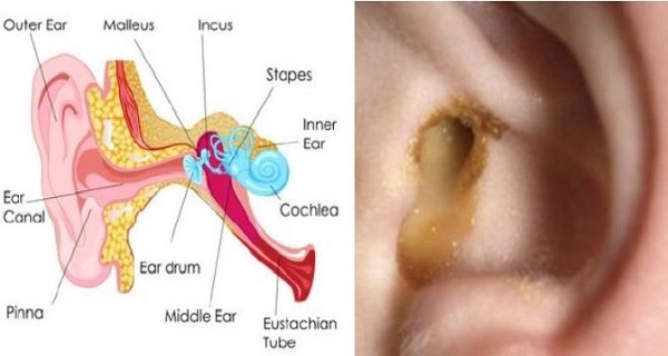 kiss the ear infection goodbye naturally