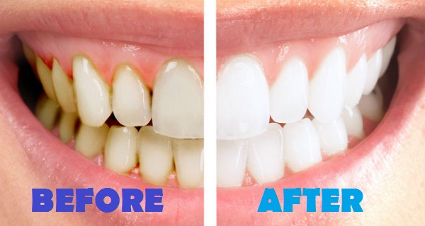 natural way to treat gum disease