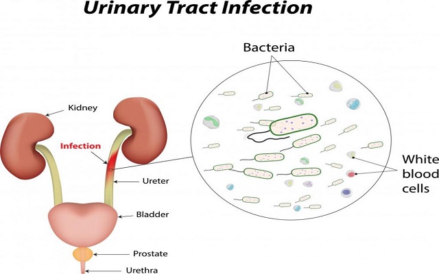 signs of an urinary tract infection