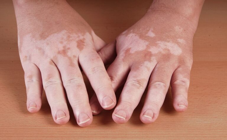 treat vitiligo