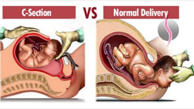 truth behind C-section vs natural delivery