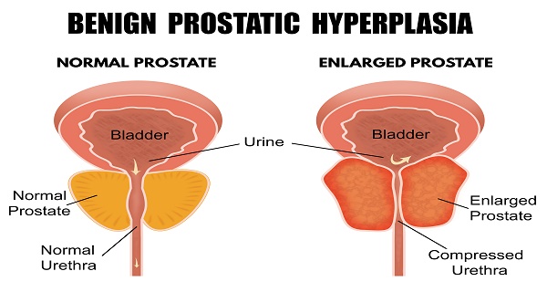 Benign prostatic hypertrophy