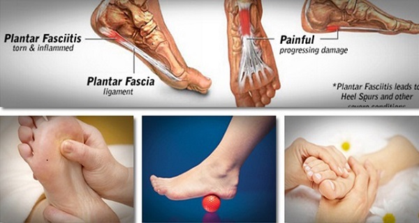 Plantar fasciitis and toe pain