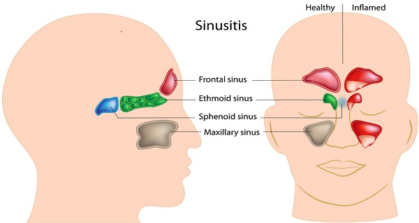 Repeated sinus infections