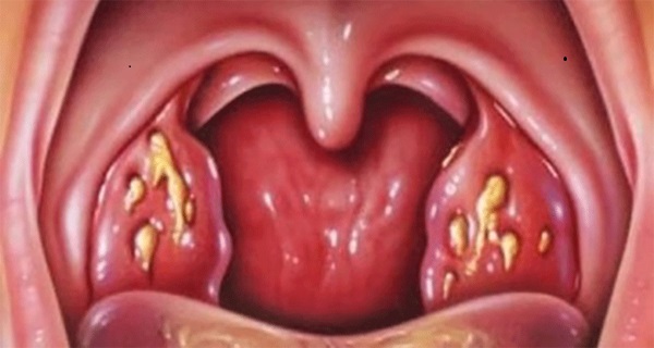 adenoid and tonsil removal