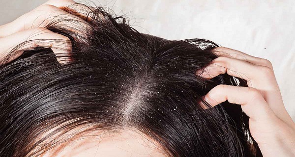 dandruff solutions at home