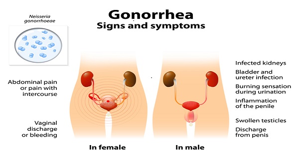 how serious is gonorrhea
