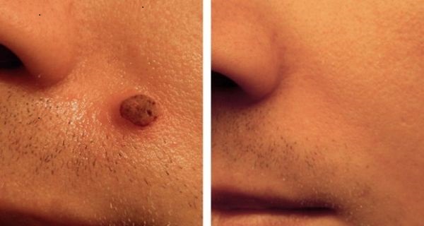 scarless mole removal