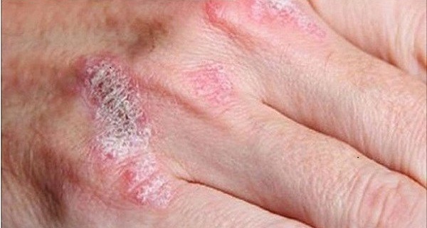 Psoriasis on fingers