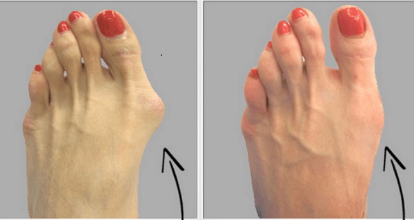 bunion on top of foot