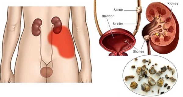 detoxification - kidney