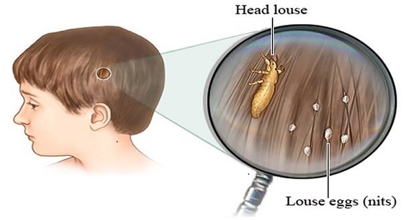 lice infection