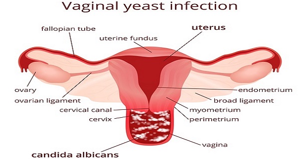 yeast infection discharge