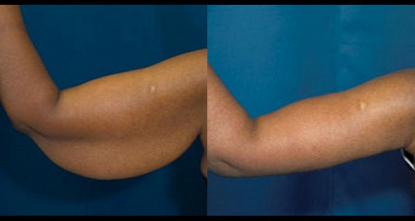 How To Get Rid Of Flabby Arms? – Doing These 5 Exercises Daily!