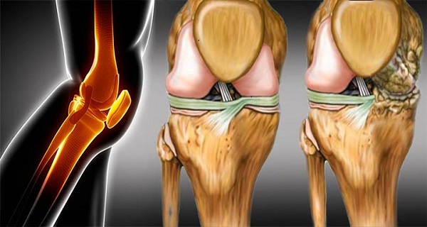 Torn knee cartilage repair