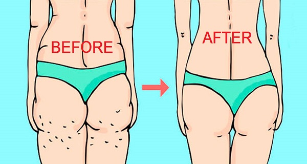 What causes cellulite