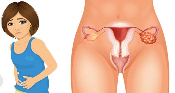 Ovarian cancer in women