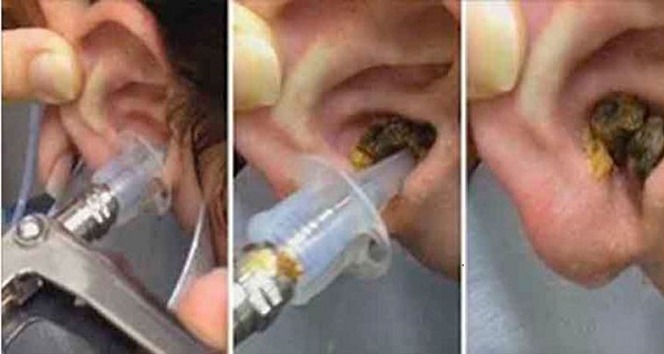 Home Remedies To Remove Too Much Ear Wax And Dirt From Your Ears!