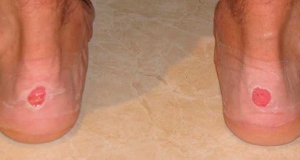 heal blisters on feet