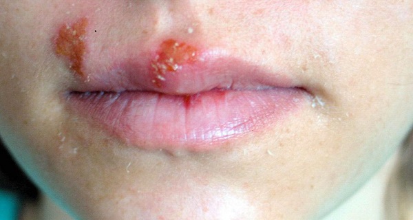 oral herpes diagnosis