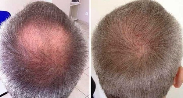 prevent male pattern baldness
