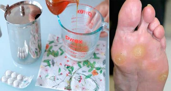 ways to get rid of calluses