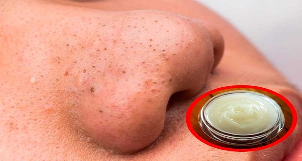 How to effectively get rid of blackheads