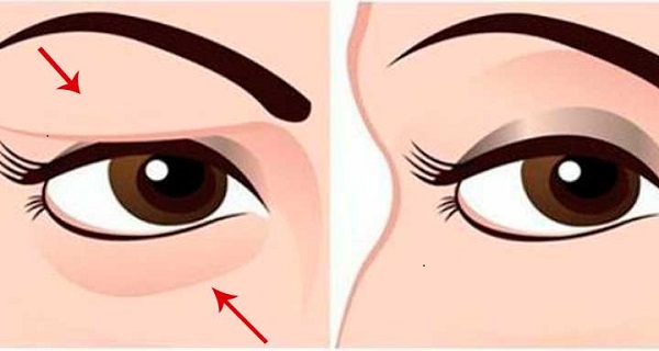 How to get rid of a lazy eyelid