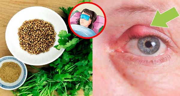 How you get a stye