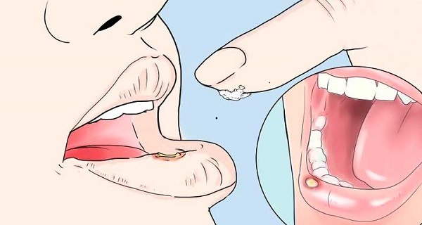 Internal cold sore