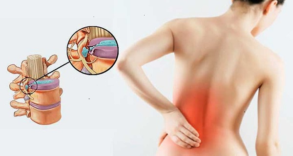 Lower back pain from herniated disc