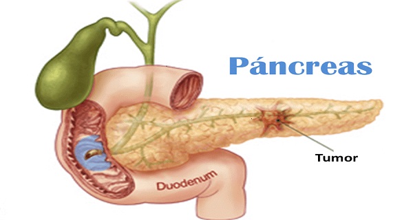 Pancreatic cancer and pain