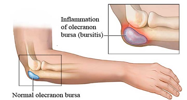 hip joint pain bursitis