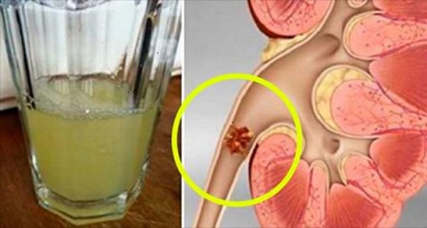 kidney stone treatment without surgery