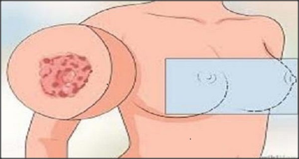 painful itchy breast