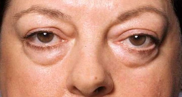 puffiness around eyes