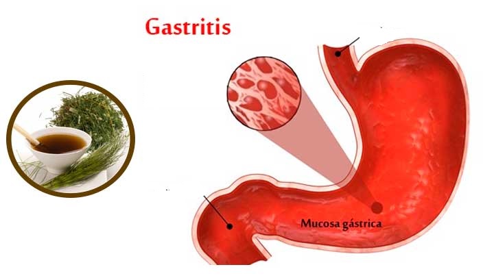 serious gastritis